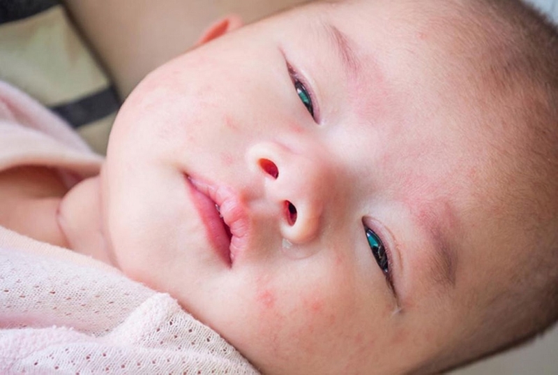 Bạch cầu cao có thể liên quan đến nhiễm trùng, viêm, dị ứng hoặc một số bệnh lý khác