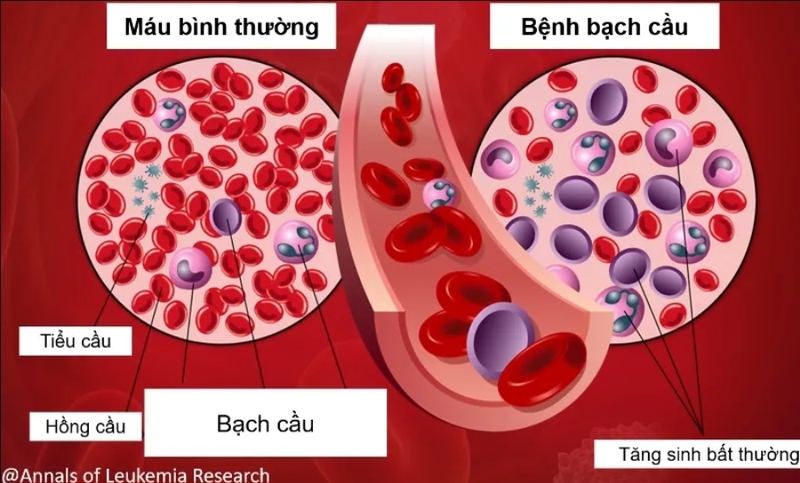 Bệnh bạch cầu là bệnh lý nghiêm trọng liên quan đến sự tăng sinh bất thường của tế bào máu
